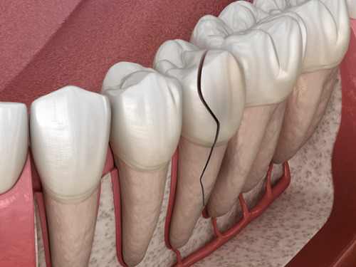 Cracked Tooth Detection Technology